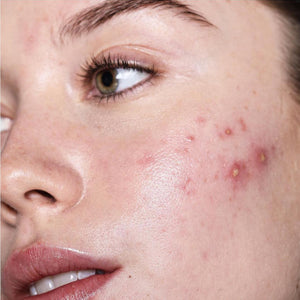 Why Your Acne Products Aren't Working