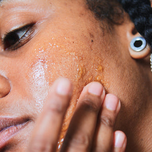 Acne Series: PIH, PIE, and Acne Scars