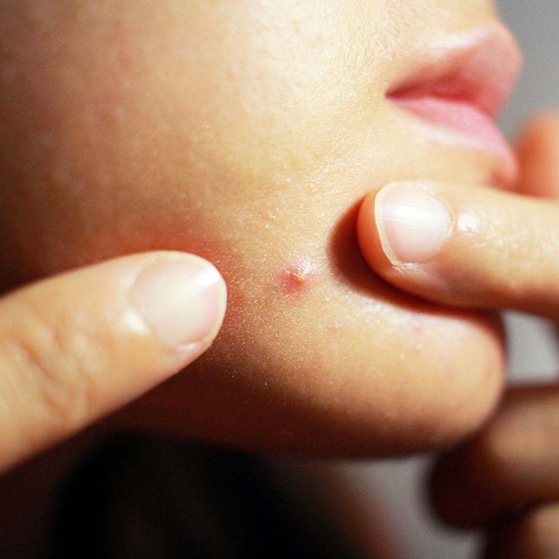 10 Skincare Mistakes That Make Your Acne Worse & Sensitize Your Skin