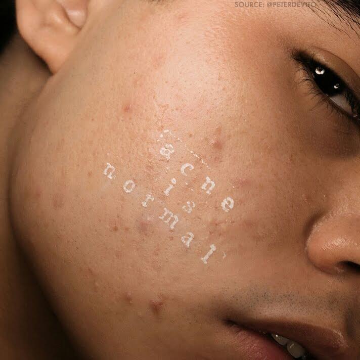 Acne Series: Demystifying Acne