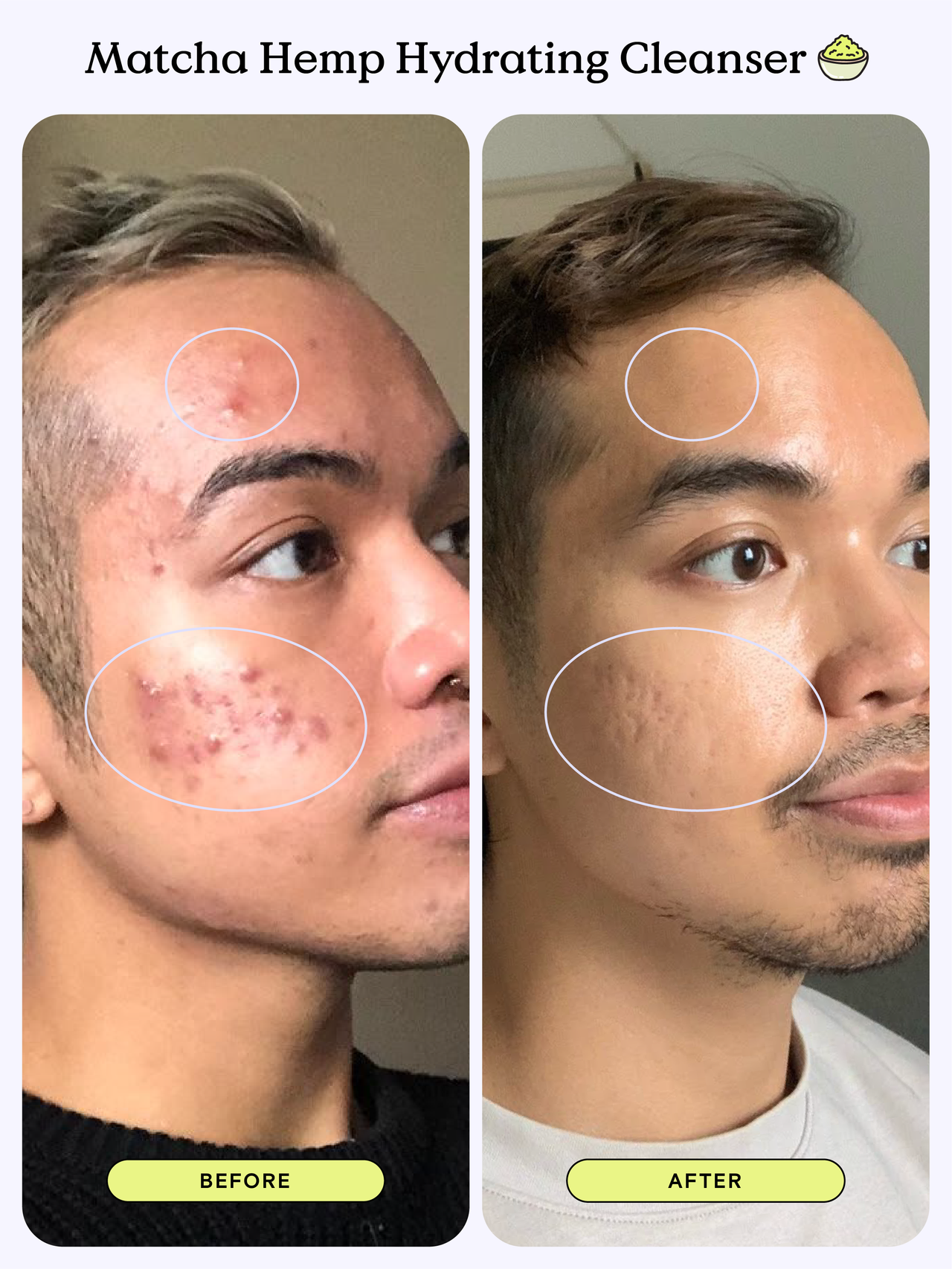 Before and After Picture of a KB community member who used Matcha Hemp Hydrating Cleanser - 1.