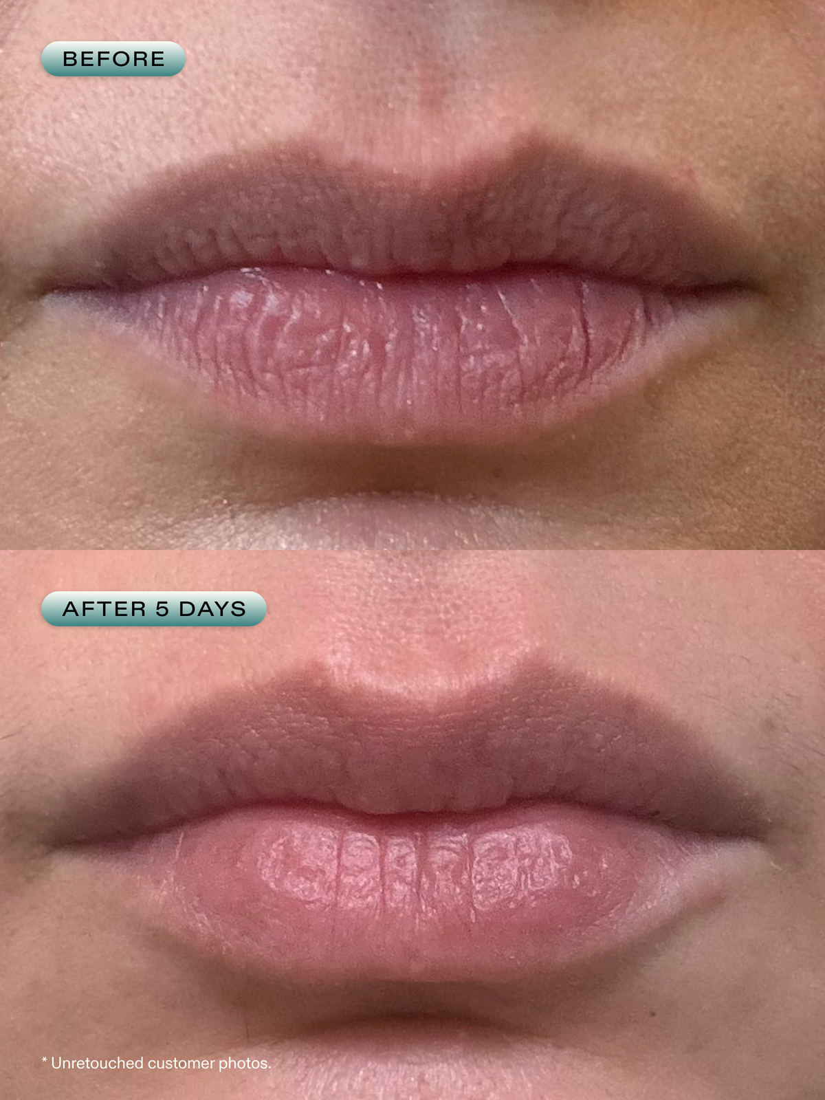 Before and after 5 days bare lips of a customer with smoother and more healthy looking lips