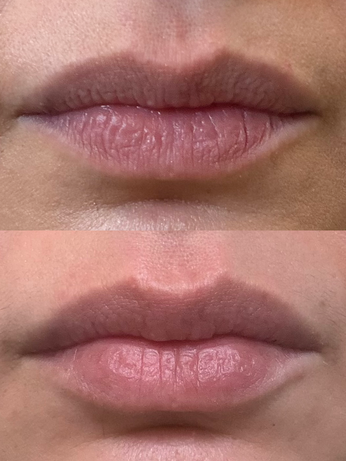 Lip Barrier Relief