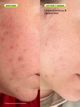 Before and after one week of using Matcha Hemp Hydrating Cleanser with calmed redness and clearer skin