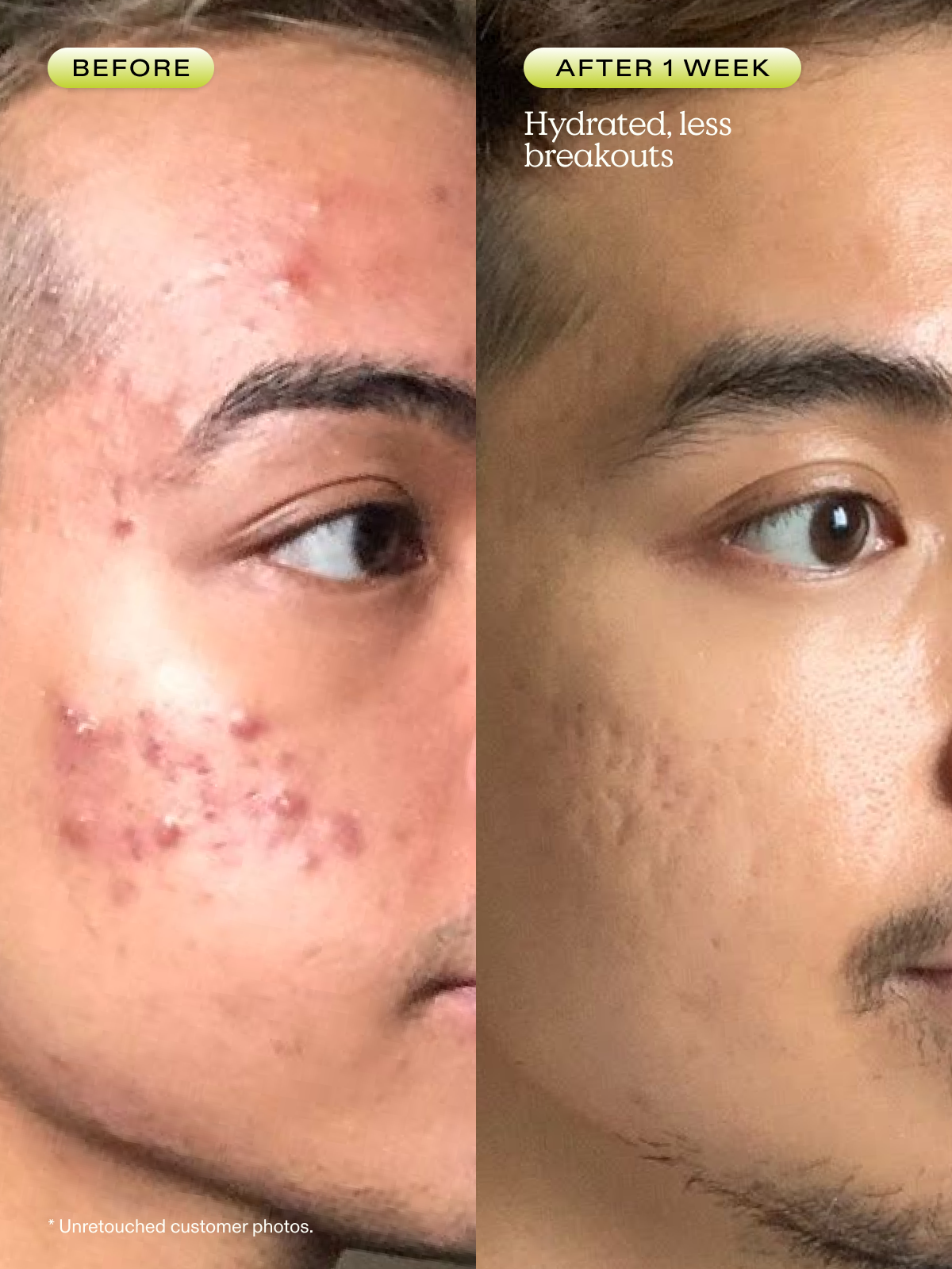 Before and after 1 week of using Matcha Hemp Hydrating Cleanser. Skin is hydrated with less breakouts