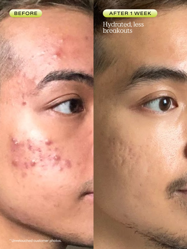 Before and after 1 week of using Matcha Hemp Hydrating Cleanser. Skin is hydrated with less breakouts