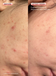 Before and after 1 week of using Oil La La with calmed redness and improved skin texture.